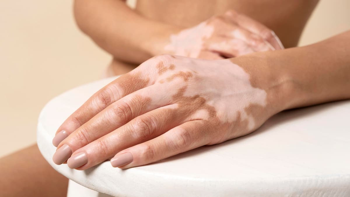 Tâches blanches sur la peau : tout savoir sur le Vitiligo