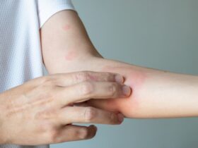 eczema de contact