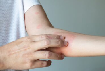 eczema de contact